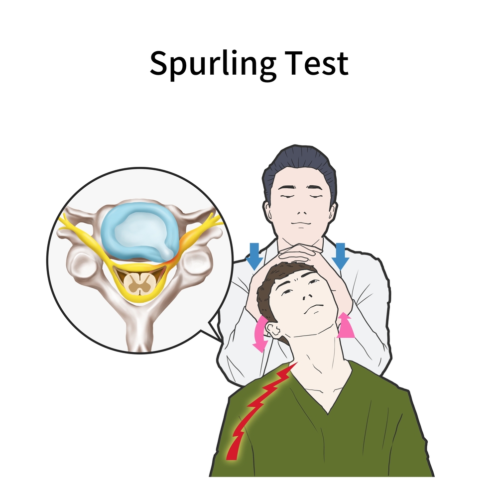 頸部肌肉僵硬＿頸椎突出測試、觀察方法＿Spurling test