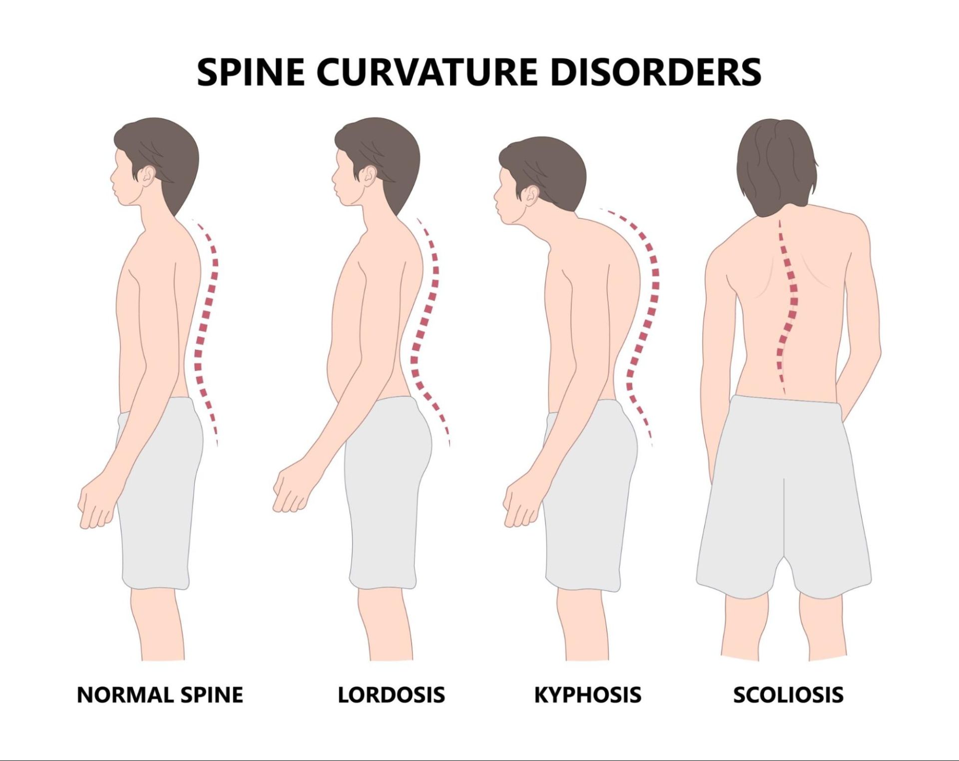 正常脊椎位置、頸椎突出、圓肩或肩膀內縮、脊椎側彎＿示意圖